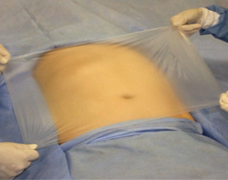 SURGICAL INCISE DRAPE